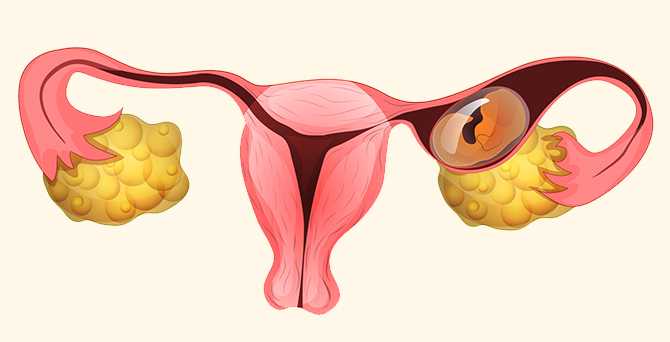 治疗卵巢癌的四大法宝：